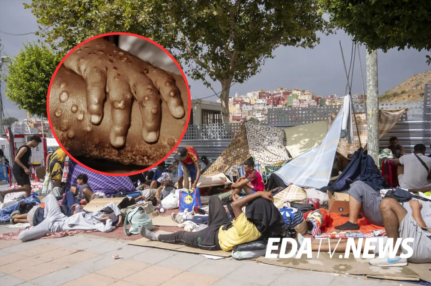 Tres semanas después del “no traen enfermedades”: Ceuta confirma un caso de viruela del mono en un menor marroquí