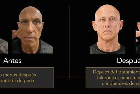 La otra cara del éxito de los GLP-1: el nuevo reto de la medicina estética